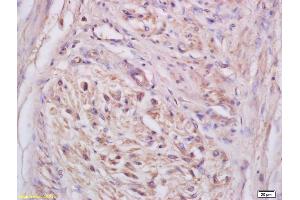 Formalin-fixed and paraffin embedded human cervical carcinoma labeled with Anti-NKG2C Polyclonal Antibody, Unconjugated (ABIN739950) at 1:200 followed by conjugation to the secondary antibody and DAB staining (KLRC2 antibody)