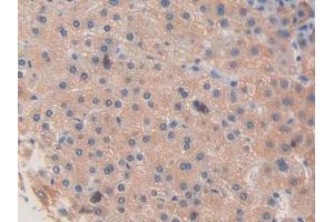 Detection of F8 in Human Liver cancer Tissue using Polyclonal Antibody to Coagulation Factor VIII (F8) (Factor VIII antibody  (AA 2253-2346))