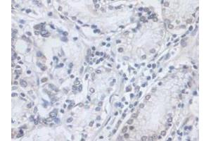 IHC-P analysis of Human Stomach Cancer Tissue, with DAB staining. (VCP antibody  (AA 125-371))
