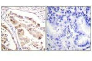 Immunohistochemistry analysis of paraffin-embedded human lung carcinoma tissue using RFA2 (Ab-21) antiobdy. (RPA2 antibody  (Thr21))