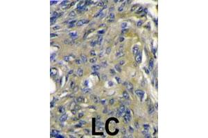 Formalin-fixed and paraffin-embedded human lung carcinoma reacted with FIGF polyclonal antibody  , which was peroxidase-conjugated to the secondary antibody, followed by DAB staining. (VEGFD antibody  (C-Term))