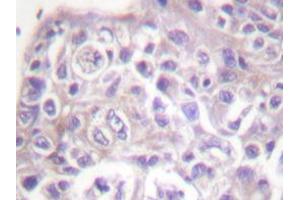 Immunohistochemistry analyzes of FKHR antibody in paraffin-embedded human breast carcinoma tissue. (FOXO1 antibody)