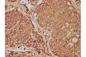 IHC image of ABIN7162214 diluted at 1:90 and staining in paraffin-embedded human liver cancer performed on a Leica BondTM system. (Oncostatin M antibody  (AA 26-220))