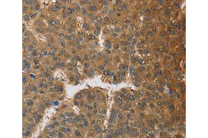 Immunohistochemistry of Human thyroid cancer using TNFRSF10D Polyclonal Antibody at dilution of 1:60 (DcR2 antibody)