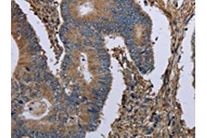 The image on the left is immunohistochemistry of paraffin-embedded Human colon cancer tissue using ABIN7130197(MCM3AP Antibody) at dilution 1/30, on the right is treated with fusion protein. (GANP antibody)