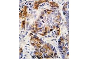 Formalin-fixed and paraffin-embedded human hepatocarcinoma tissue reacted with ALDH4A1 antibody (Center), which was peroxidase-conjugated to the secondary antibody, followed by DAB staining. (ALDH4A1 antibody  (AA 288-314))