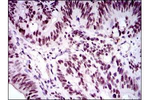 Immunohistochemical analysis of paraffin-embedded rectum cancer tissues using FOXP1 mouse mAb with DAB staining. (FOXP1 antibody  (AA 481-677))