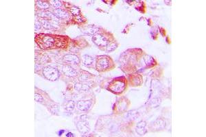Immunohistochemical analysis of STEAP1 staining in human lung cancer formalin fixed paraffin embedded tissue section.