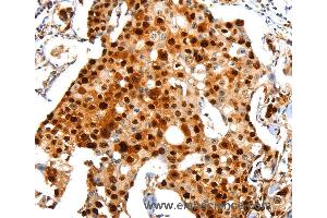 Immunohistochemistry of Human breast cancer using PCNA Polyclonal Antibody at dilution of 1:44 (PCNA antibody)