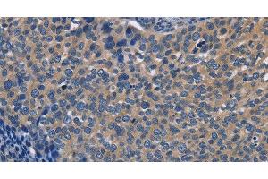 Immunohistochemistry of paraffin-embedded Human cervical cancer using SYT17 Polyclonal Antibody at dilution of 1:60 (SYT17 antibody)
