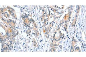Immunohistochemistry of paraffin-embedded Human colon cancer using Placental Alkaline Phosphatase Polyclonal Antibody at dilution of 1:50 (PLAP antibody)