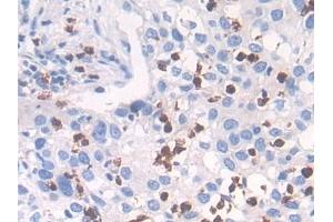 Detection of CTSG in Human Lung cancer Tissue using Polyclonal Antibody to Cathepsin G (CTSG) (Cathepsin G antibody  (AA 21-255))
