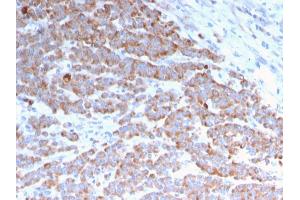 Formalin-fixed, paraffin-embedded human Colon Carcinoma stained with Cytokeratin 18 Mouse Monoclonal Antibody (rKRT18/1190). (Recombinant Cytokeratin 18 antibody)