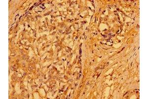 Immunohistochemistry of paraffin-embedded human breast cancer using ABIN7165690 at dilution of 1:100 (PACSIN3 antibody  (AA 1-300))