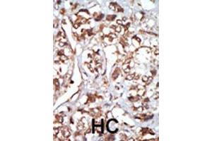 Formalin-fixed and paraffin-embedded human cancer tissue reacted with the primary antibody, which was peroxidase-conjugated to the secondary antibody, followed by AEC staining. (EIF2AK1 antibody  (N-Term))