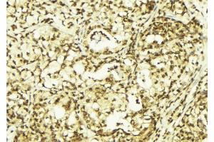 ABIN6269042 at 1/100 staining Human breast cancer tissue by IHC-P. (HSPB6 antibody  (N-Term))