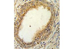 Immunohistochemistry analysis in formalin fixed and paraffin embedded prostate carcinoma reacted with HAPLN1 Antibody (N-term) followed which was peroxidase conjugated to the secondary antibody and followed by DAB staining. (HAPLN1 antibody  (N-Term))