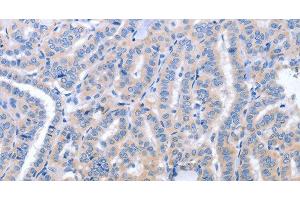 Immunohistochemistry of paraffin-embedded Human thyroid cancer using B3GAT1 Polyclonal Antibody at dilution of 1:40 (CD57 antibody)