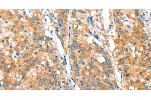 Immunohistochemistry of paraffin-embedded Human gasrtic cancer tissue using ST14 Polyclonal Antibody at dilution 1:70 (ST14 antibody)