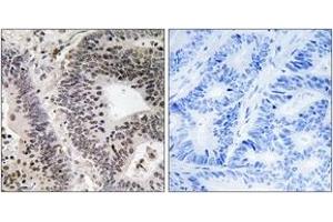 Immunohistochemistry analysis of paraffin-embedded human colon carcinoma, using WWOX (Phospho-Tyr33) Antibody.