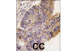 Formalin-fixed and paraffin-embedded human colon carcinoma tissue reacted with RPS6KA1 Antibody , which was peroxidase-conjugated to the secondary antibody, followed by DAB staining.