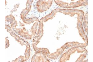 Formalin-fixed, paraffin-embedded human prostate carcinoma stained with Interleukin 10 Recombinant Rabbit Monoclonal Antibody (IL10/2651R). (Recombinant IL-10 antibody)