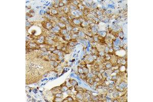 Immunohistochemistry of paraffin-embedded human lung cancer using CYLD Rabbit pAb (ABIN1679467, ABIN3018138, ABIN3018139 and ABIN6220378) at dilution of 1:100 (40x lens). (CYLD antibody  (AA 654-953))