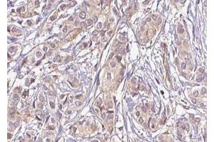 ABIN6269375 at 1/100 staining Human breast cancer tissue by IHC-P. (DPYSL2 antibody  (C-Term))