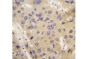 Immunohistochemical staining of formalin-fixed and paraffin-embedded human hepatocarcinoma tissue reacted with ATG12 monoclonal antibody  at 1:50-1:200 dilution. (ATG12 antibody)
