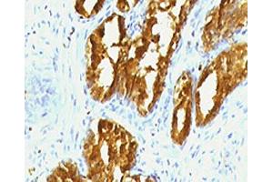 IHC testing of human prostate carcinoma with PSAP antibody (clone PSPN1-1). (Prosaposin antibody)