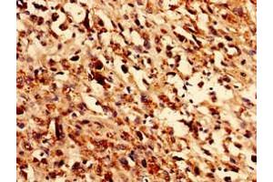 Immunocytochemistry analysis of human melanoma using ABIN7162002 at dilution of 1:100 (GLE1 antibody  (AA 141-380))