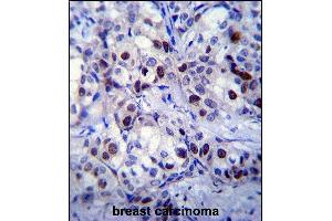 RB1 Antibody  (ABIN1881730 and ABIN2840685) immunohistochemistry analysis in formalin fixed and paraffin embedded human breast carcinoma followed by peroxidase conjugation of the secondary antibody and DAB staining.