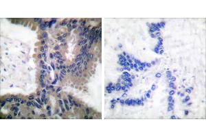Peptide - +Immunohistochemical analysis of paraffin-embedded human lung carcinoma tissue using Cullin 1 antibody (#C0162). (Cullin 1 antibody)
