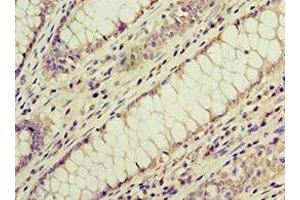 Immunohistochemistry of paraffin-embedded human colon cancer using ABIN7143179 at dilution of 1:100 (ACVR1C/ALK7 antibody  (AA 22-113))