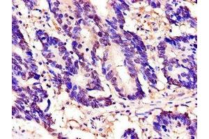 Immunohistochemistry of paraffin-embedded human colon cancer using ABIN7172305 at dilution of 1:100 (TOR1A antibody  (AA 88-125))