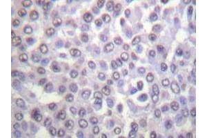 Immunohistochemistry analyzes of Histone H4 antibody in paraffin-embedded human breast carcinoma tissue. (Histone H4 antibody)