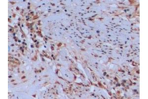 Detection of TYMS in Human Endometrial cancer Tissue using Polyclonal Antibody to Thymidylate Synthetase (TYMS) (TYMS antibody  (AA 36-313))