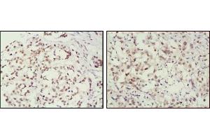 Immunohistochemical analysis of paraffin-embedded human breast cancer (left) and lung cancer (right) tissues, showing nuclear localization using MSH2 antibody with DAB staining. (MSH2 antibody)