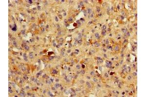 Immunohistochemistry of paraffin-embedded human melanoma using ABIN7145531 at dilution of 1:100 (BACE1 antibody  (AA 46-155))