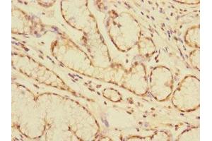 Immunohistochemistry of paraffin-embedded human colon cancer using ABIN7146795 at dilution of 1:100 (CEACAM4 antibody  (AA 36-155))