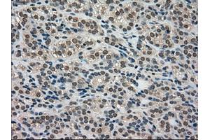 Immunohistochemical staining of paraffin-embedded Adenocarcinoma of breast tissue using anti-LDHA mouse monoclonal antibody. (Lactate Dehydrogenase A antibody)