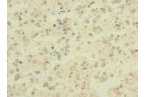 Immunohistochemistry of paraffin-embedded human glioma using ABIN7143380 at dilution of 1:100
