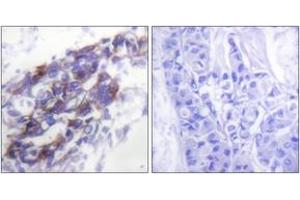 Immunohistochemistry analysis of paraffin-embedded human breast carcinoma tissue, using Keratin 8 Antibody.