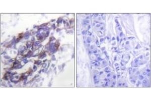 Immunohistochemistry analysis of paraffin-embedded human breast carcinoma tissue, using Keratin 8 Antibody. (KRT8 antibody  (AA 434-483))