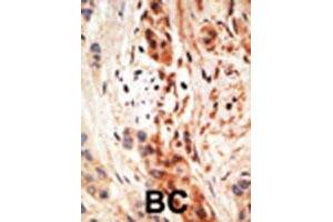Formalin-fixed and paraffin-embedded human cancer tissue reacted with the APOBEC3A polyclonal antibody  , which was peroxidase-conjugated to the secondary antibody, followed by AEC staining. (APOBEC3A antibody  (N-Term))