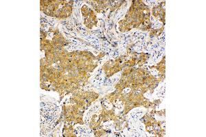 Anti-Hsc70 antibody, IHC(P) IHC(P): Human Lung Cancer Tissue (Hsc70 antibody  (C-Term))