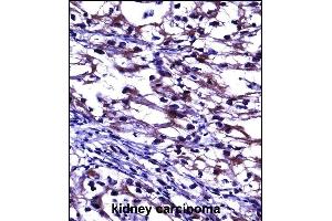 TNFRSF11B Antibody (Center) ((ABIN657660 and ABIN2846654))immunohistochemistry analysis in formalin fixed and paraffin embedded human kidney carcinoma followed by peroxidase conjugation of the secondary antibody and DAB staining. (Osteoprotegerin antibody  (AA 243-271))