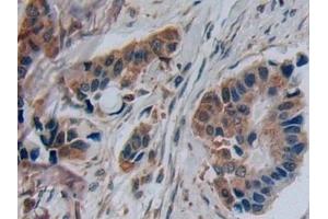 Detection of DISC1 in Human Breast cancer Tissue using Polyclonal Antibody to Disrupted In Schizophrenia 1 (DISC1)