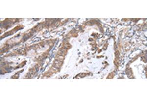 Immunohistochemistry of paraffin-embedded Human esophagus cancer tissue using WWP1 Polyclonal Antibody at dilution of 1:40(x200)