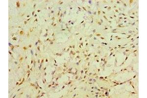 Immunohistochemistry of paraffin-embedded human breast cancer using ABIN7166493 at dilution of 1:100 (Ret Proto-Oncogene antibody  (AA 29-300))